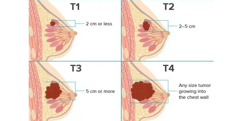 Các giai đoạn của bệnh ung thư vú thể hiện tăng sinh tế bào ung thư