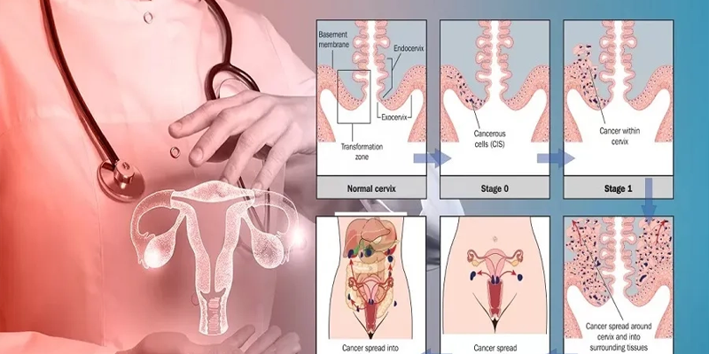 Hình ảnh minh họa chi tiết các giai đoạn tiến triển của ung thư cổ tử cung từ khi còn tại chỗ đến khi di căn xa