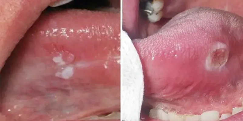 Các giai đoạn của ung thư lưỡi