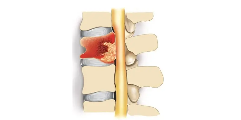 Các khối u tủy sống gồm u nội tủy và u ngoài tủy