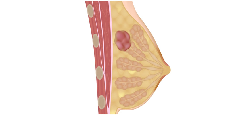 U xơ tuyến thường biểu hiện bằng một khối u rắn (không chứa chất lỏng) ở 1 hoặc cả 2 vú.