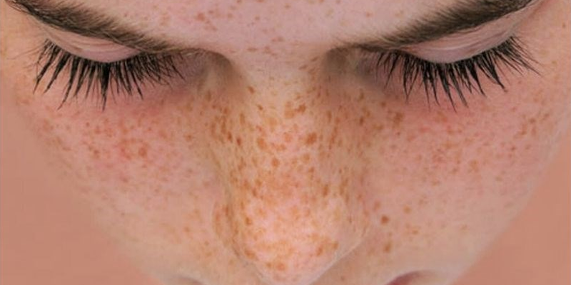 Ánh nắng mặt trời là một trong số những nguyên nhân gây ung thư da