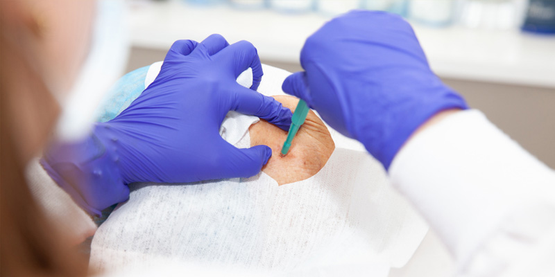 Sinh thiết phổi bằng kim và nội soi giúp giảm đau cho bệnh nhân