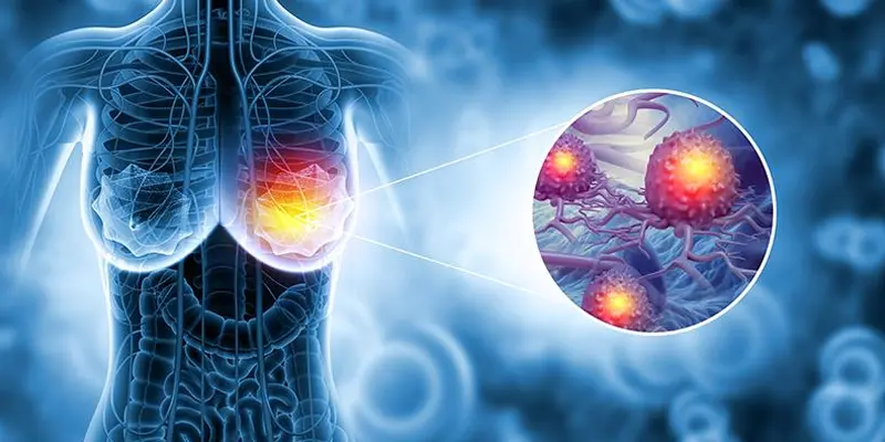 Bức xạ được sử dụng sau phẫu thuật cắt bỏ vú sẽ tiêu diệt bất kỳ tế bào ung thư nào còn sót lại