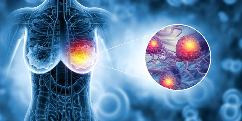 Trước buổi điều trị đầu tiên, người bệnh sẽ trải qua 1 buổi mô phỏng – lập kế hoạch xạ trị ung thư vú