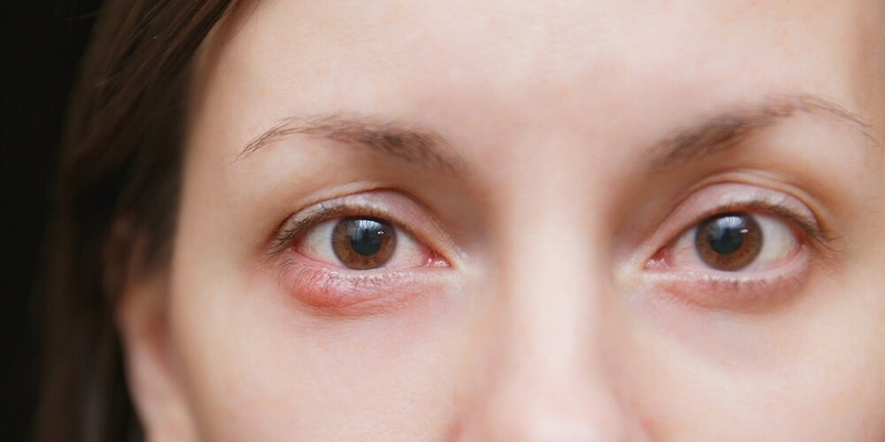 Các u lymphô ác tính ở mi mắt có thể làm dày mi