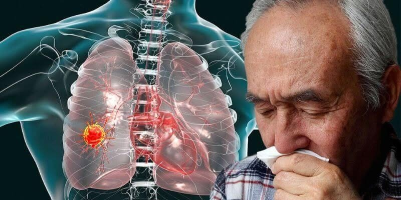 Ung thư tế bào thận là dạng ung thư khá phổ biến
