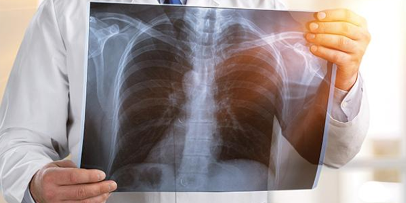 Phương pháp điều trị khối u ở phổi được bác sĩ chỉ định dựa trên tình trạng bệnh cụ thể