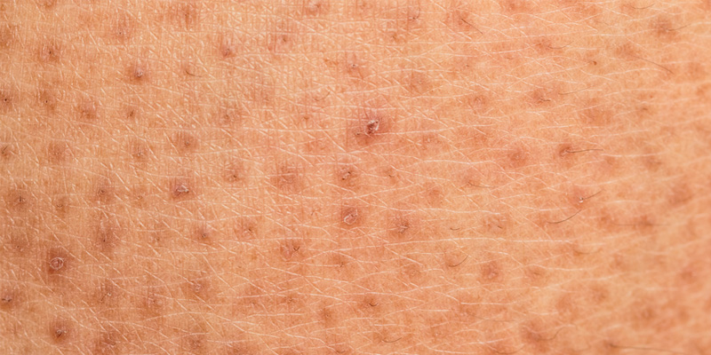 Da vú sần sùi như vỏ cam là một hình ảnh ung thư vú có thể gợi ý cho bạn