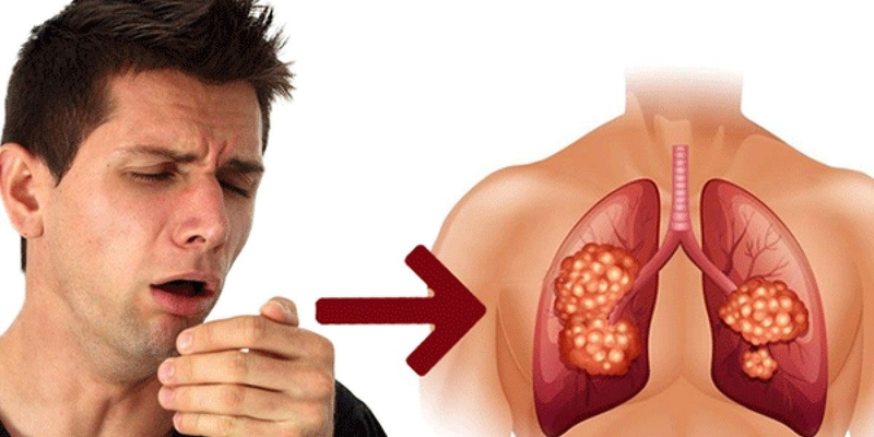 Phân biệt lao phổi và ung thư phổi