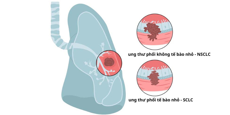 Có hai dạng ung thư chính gồm ung thư phổi tế bào nhỏ (SCLC) và ung thư phổi không tế bào nhỏ (NSCLC)