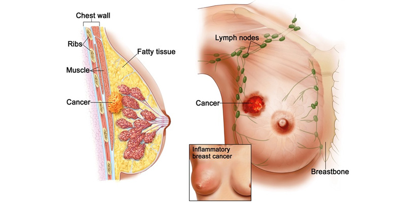 Ung thư vú là một căn bệnh ác tính từ mô tuyến vú