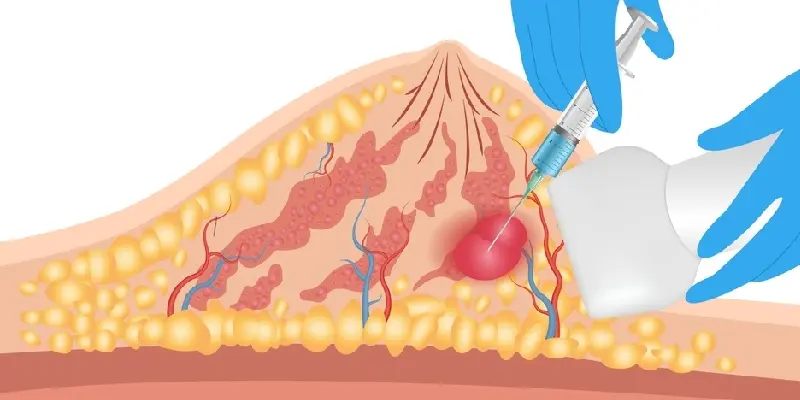 Sinh thiết vú là thủ thuật sử dụng kim sinh thiết để lấy mẫu mô mang đi xét nghiệm nhằm tìm kiếm dấu hiệu ung thư