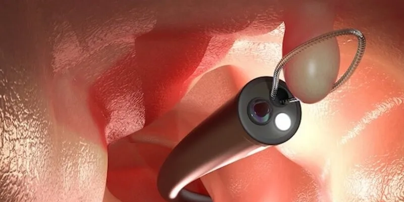 Nội soi cổ tử cung cắt polyp thường được lựa chọn khi polyp nằm sâu, khó quan sát bằng thăm khám thông thường