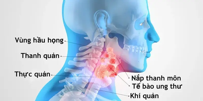 Câu hỏi ung thư vòm họng có nguy hiểm không, câu trả lời là có