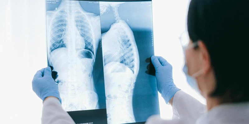 Chụp X-quang phổi có thể giúp phát hiện các dấu hiệu của tình trạng xơ hóa phổi