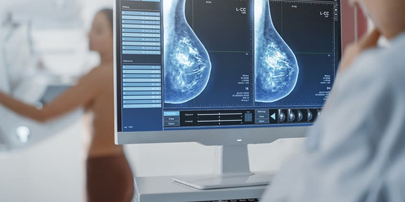 Chụp nhũ ảnh giúp phát hiện và sàng lọc các bệnh lý tuyến vú, trong đó có u nang tuyến vú