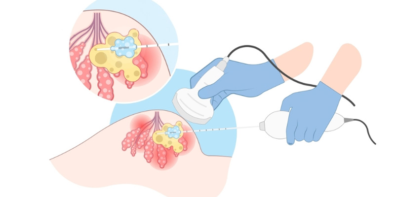 Quá trình sinh thiết lõi kim
