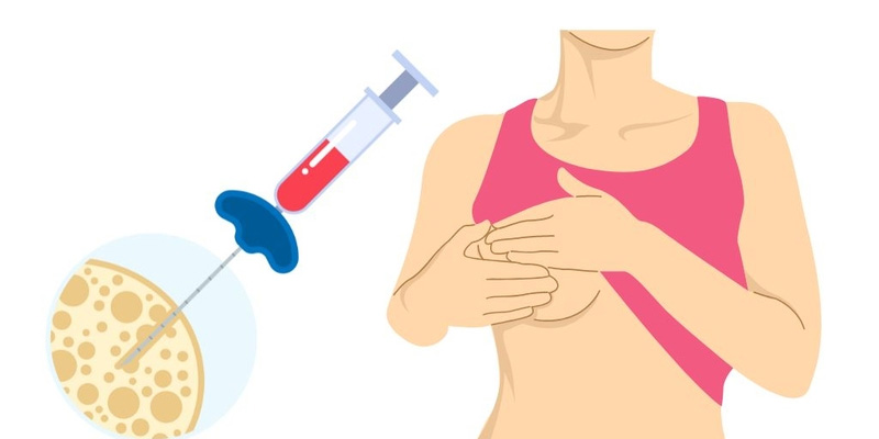 Sinh thiết lõi kim (Core Needle Biopsy) giúp xác định xem khối u là lành tính hay ác tính