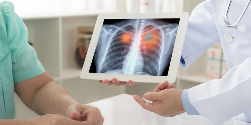 Cần thực hiện các xét nghiệm chuyên sâu để phát hiện ung thư phổi