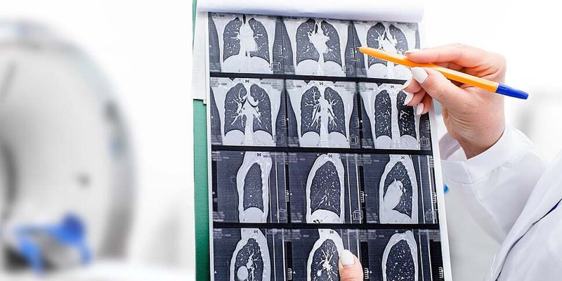 Chụp CT ngực liều thấp (LDCT) là phương pháp tầm soát ung thư phổi được các chuyên gia khuyến nghị