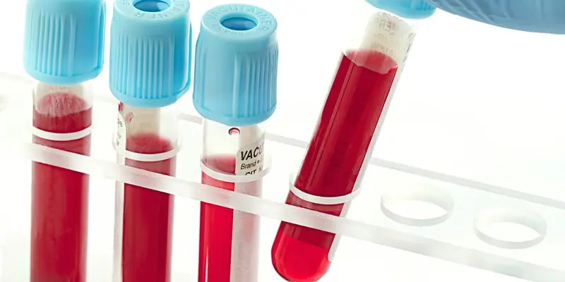 Xét nghiệm máu là một trong những phương pháp chẩn đoán ung thư thận