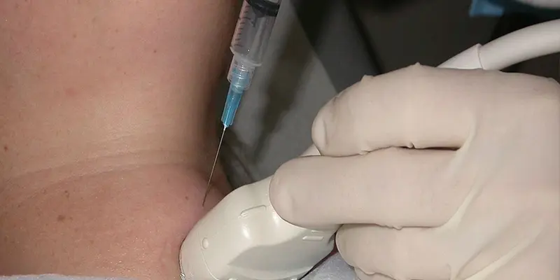 Sinh thiết FNA là một trong những phương pháp có thể chỉ định để chẩn đoán ung thư tuyến giáp giai đoạn 2