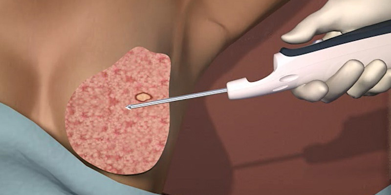 chẩn đoán ung thư vú bằng cách sinh thiết vú