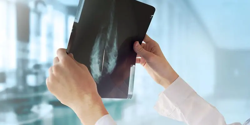 Ung thư vú dạng nhú có thể nhìn thấy qua phim chụp nhũ ảnh nhưng rất giống bướu lành tính của vú