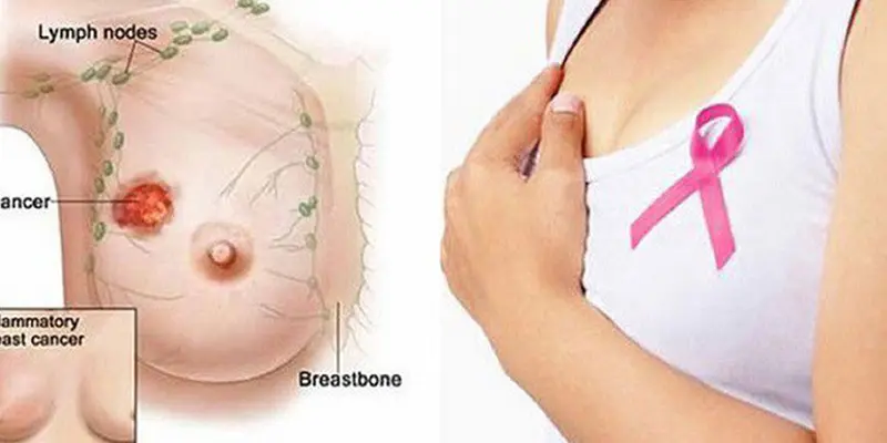 Ung thư vú dạng sàng rất hiếm gặp