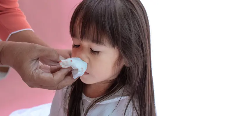 Chảy máu cam bất thường là triệu chứng ung thư vòm họng ở trẻ em