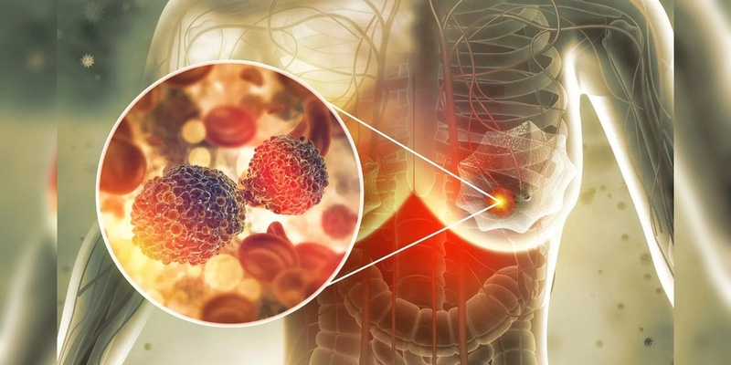 Liệu pháp nội tiết trong điều trị ung thư vú chỉ định để giảm kích thước của khối u