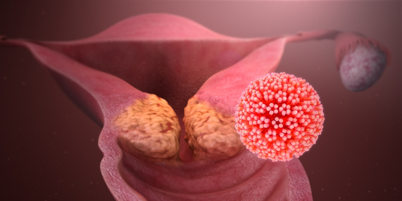 HPV là một trong những nguyên nhân hàng đầu gây ung thư cổ tử cung