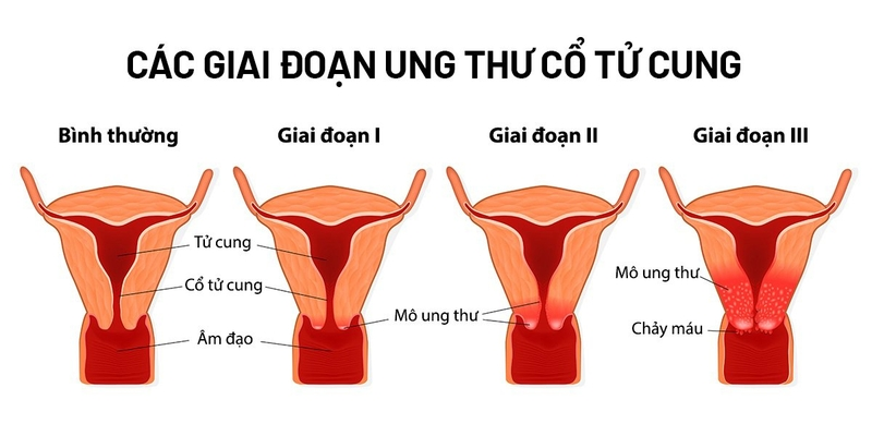Các giai đoạn ung thư cổ tử cung