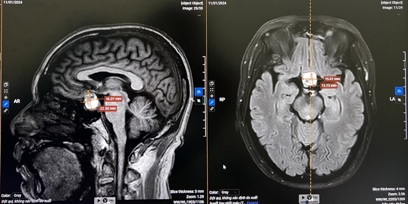Chẩn đoán ung thư não bằng MRI