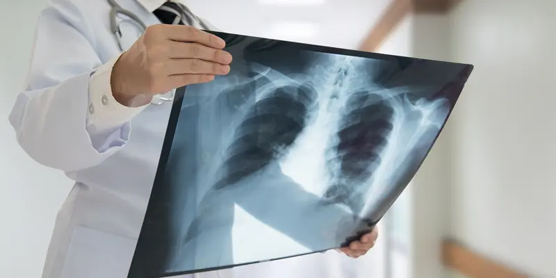 Chụp X-quang phổi là phương pháp chẩn đoán ung thư thanh quản