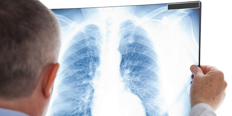 Ung thư phổi tế bào nhỏ nguy hiểm nhất