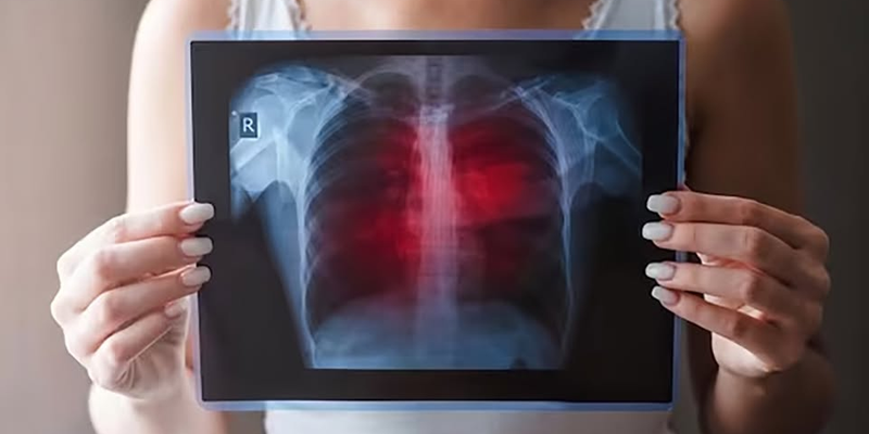 Amivantamab là thuốc điều trị ung thư phổi không tế bào nhỏ, đặc biệt hiệu quả trong các trường hợp có đột biến EGFR