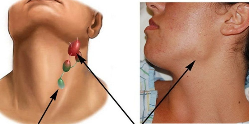 U lympho Hodgkin vị trí khởi phát là hạch