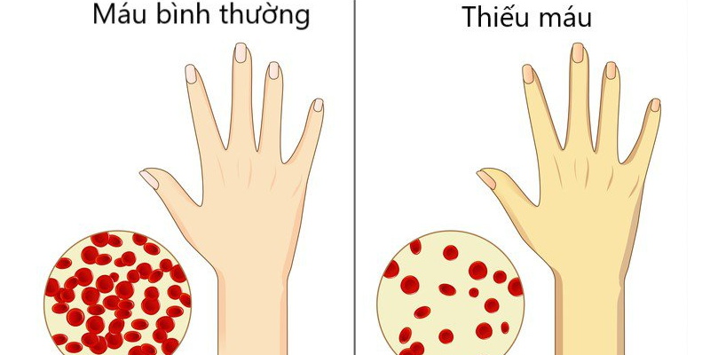 Thiếu máu kéo dài cũng là một trong những dấu hiệu đa u tủy xương