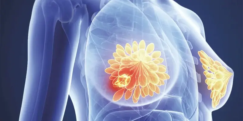 Dấu hiệu nhận biết khối u ung thư vú chị em không nên bỏ qua