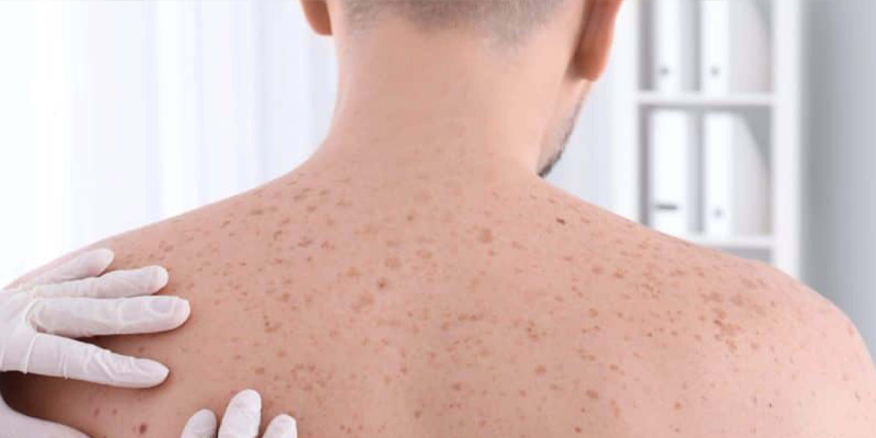 Ung thư da biểu mô tế bào đáy dễ nhầm lẫn với ung thư hắc tố