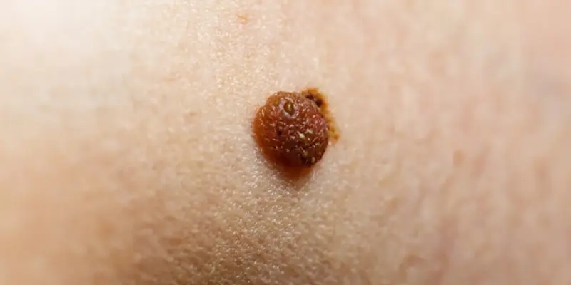 Da xuất hiện các nốt như mụn cóc