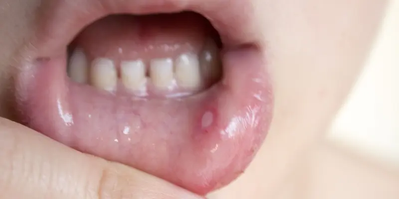 Ung thư lưỡi giai đoạn cuối ảnh hưởng nghiêm trọng đến sức khỏe