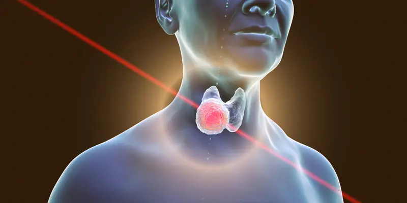 Ung thư tuyến giáp thể thú là loại thường gặp nhất trong ung thư tuyến giáp