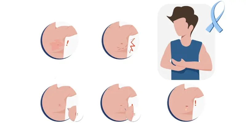 Dấu hiệu ung thư vú ở nam giới cần biết sớm