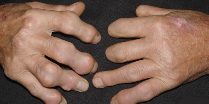 Sưng phồng do khối u là một trong các dấu hiệu của bệnh ung thư xương