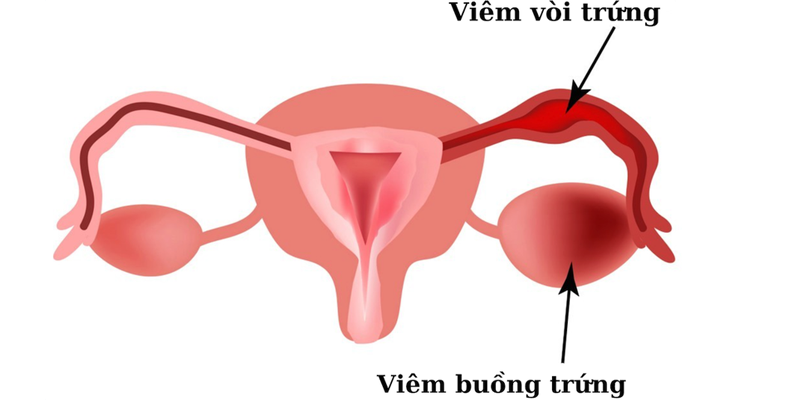 Biến chứng thường gặp của viêm cổ tử cung là các biểu hiện viêm vùng chậu