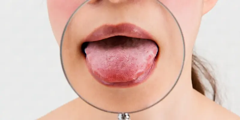 Đau rát lưỡi là cảm giác nóng rát trên lưỡi