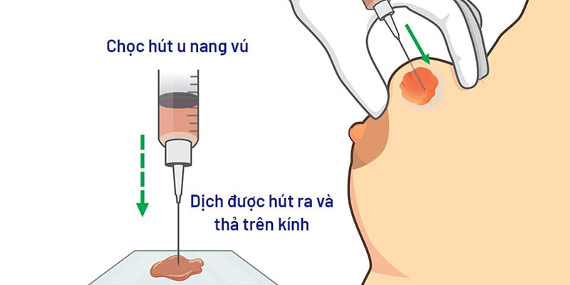 Quy trình chọc kim nhỏ vào u nang vú cần được thực hiện bởi các bác sĩ, kỹ thuật viên có chuyên môn